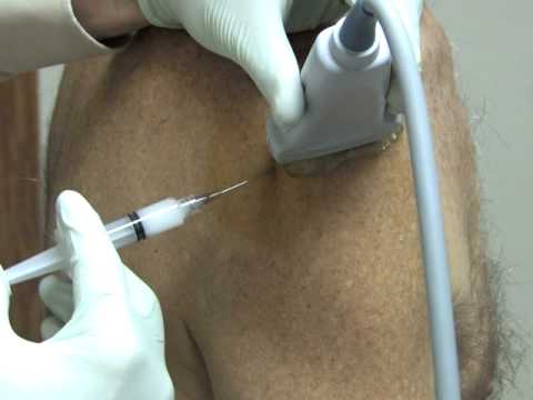 Image guided steroid injections