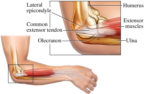Complications of steroid injection for tennis elbow